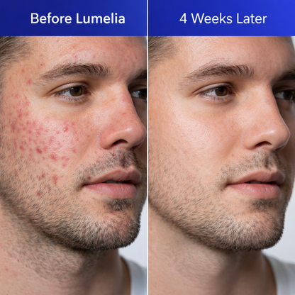 Lumelia Clearionix™ Acne Slayer